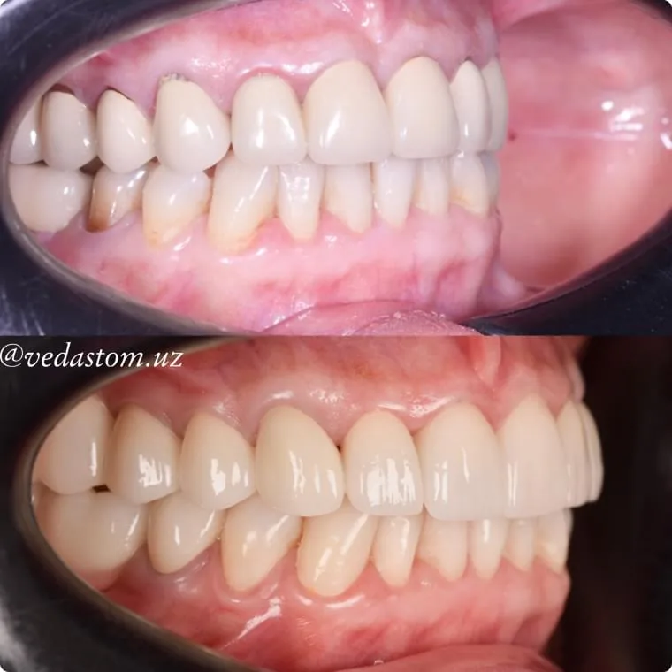 Циркониевые коронки
